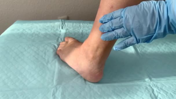 Lekarz Pielęgniarka Niebieskich Rękawiczkach Dotyka Rany Kobiecej Nodze Lekiem Koncepcja — Wideo stockowe