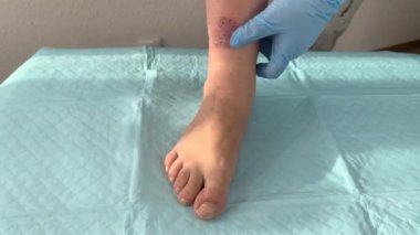 Doktor, hemşire, mavi eldivenli, kadın bacağındaki yarayı ilaçla, tıbbi konseptle sarmış.
