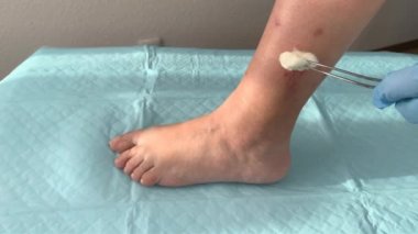 Doktor, hemşire, mavi eldivenli, ilaçla iyileştiriyor kadın bacağında ilaç, yara tedavisi, ağır çekimde çekim