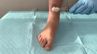 Doktor, hemşire, mavi eldivenli, ilaçla iyileştiriyor kadın bacağında ilaç, yara tedavisi, ağır çekimde çekim