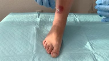 Doktor, hemşire, mavi eldivenli, ilaçla iyileştiriyor kadın bacağında ilaç, yara tedavisi, ağır çekimde çekim