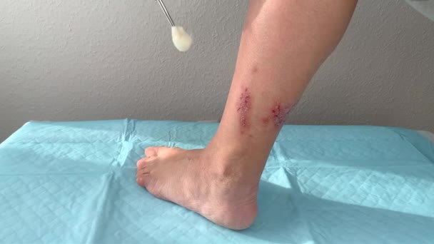 간호사 장갑을 다리에 상처를 약으로 치료하고 치료를 — 비디오