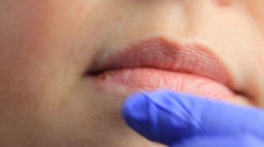 Eldivenli doktor uçuk ve uçuktan yara almış bir kızın dudaklarını okşuyor. dudak tedavisi, ağır çekim, kopyalama alanı