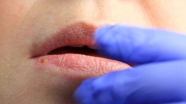 Eldivenli doktor uçuk ve uçuktan yara almış bir kızın dudaklarını okşuyor. dudak tedavisi, ağır çekim, kopyalama alanı