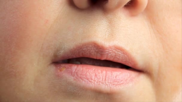 Mujer Con Llagas Por Herpes Los Labios Herpes Tratamiento Labios — Vídeo de stock