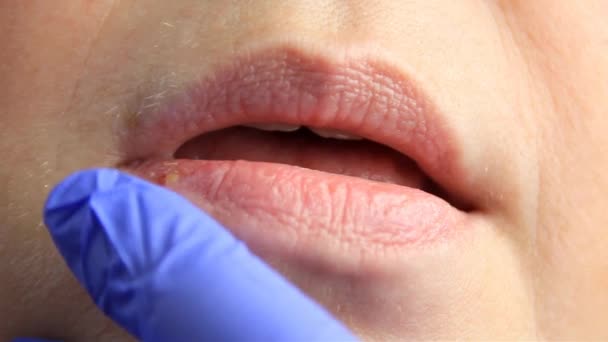 戴眼镜的医生摸着一个得疱疹和疱疹的女孩的嘴唇 唇处理 慢动作射击 复制空间 — 图库视频影像