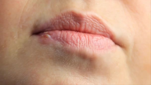 Vrouw Met Zweren Van Herpes Haar Lippen Herpes Lipbehandeling Slow — Stockvideo