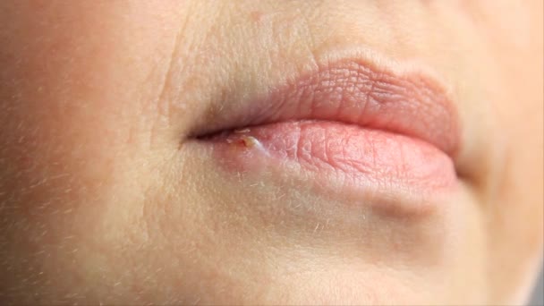 Frau Mit Wunden Von Herpes Auf Den Lippen Herpes Lippenbekenntnis — Stockvideo