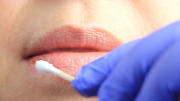 手袋の医者はヘルペス ヘルペスの痛みを持つ少女の唇に綿棒クリームを適用します 唇治療 スローモーション撮影 コピースペース — ストック動画