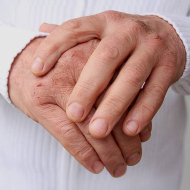 Kuru deri hasarı olan erkek ellerini kapat. Dermatoloji kavramı. İnsan eli ve derisi çatlaklara ve yaralara sahiptir. İnsan elleri yakın.