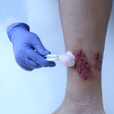 Yakın çekim hemşiresi, ayak bileğindeki bir yarayı üst deride hasar ve ülser tedavisinde kullanılan tıbbi konsept ile tedavi eder.