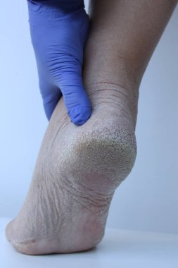 Ayakta yakın plan, deride hasar, üst deride deri dökülmesi. Dermatoloji, tıbbi konsept. Derisi kuru ve çatlaklı insan bacakları.