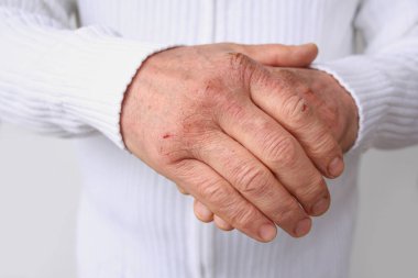 Kuru deri hasarı olan erkek ellerini kapat. Dermatoloji kavramı. İnsan eli ve derisi çatlaklara ve yaralara sahiptir. İnsan elleri yakın.