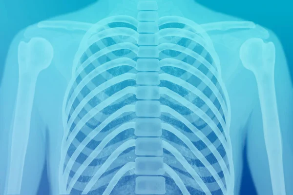 Radiografía Del Tórax Humano Concepto Examen Preventivo Tratamiento Lesiones Enfermedades — Foto de Stock
