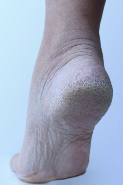 Ayağın topuğuna yakın plan, deride hasar, üst deride deri dökülmesi. Dermatoloji, tıbbi konsept. Derisi kuru ve çatlaklı insan bacakları.