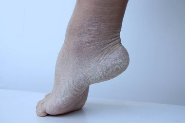 Kadın ayağına yakın, topuğu kuru, kötü çatlamış deri ve çatlaklarla dolu. Dermatoloji, medikal, kozmetik konsept deri yüzen insan ayakları