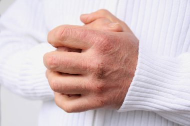 Kuru deri hasarı olan erkek ellerini kapat. Dermatoloji kavramı. İnsan eli ve derisi çatlaklara ve yaralara sahiptir. İnsan elleri yakın.