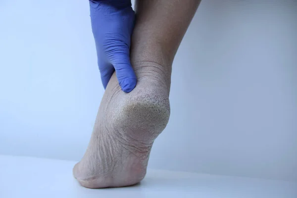 close-up of the foot with damage to dry skin, exfoliation of the epidermis. Dermatology, medical concept. Human legs with skin with dryness and cracks