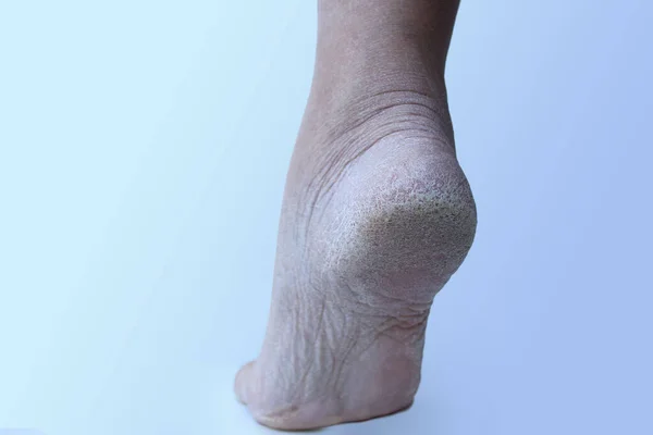 Nahaufnahme Der Ferse Des Fußes Mit Schädigung Der Trockenen Haut — Stockfoto