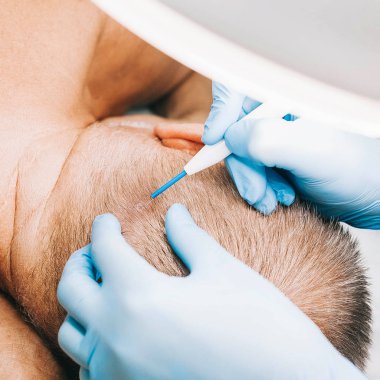 Doktor-güzellik uzmanı bir doğum lekesi, kaldırmak için bir insan kafası kozmetik ameliyat mı siğiller