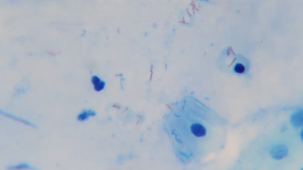mycobactérie tuberculeuse dans les expectorations humaines au microscope 