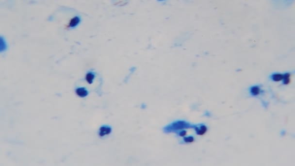 Mikobaktérium Tuberkulózis Baktériumok Emberi Köpetben Mikroszkóp Alatt — Stock videók