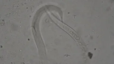 Strongyloides stercoralis mikroskop altında insan dışkısı. laboratuarda test ediliyor