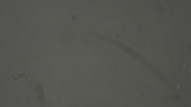 Laboratuvarda mikroskop altında insan idrar tortusu.