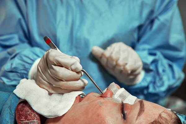 Un cirujano con guantes está operando su nariz. Rinoplastia, operación de primer plano. Luz azul, trabajo en equipo, salud, belleza . —  Fotos de Stock