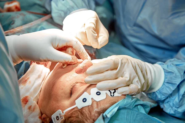 A surgeon with gloves is operating on his nose. Rhinoplasty, close-up operation. Blue light, teamwork, health, beauty. — 스톡 사진