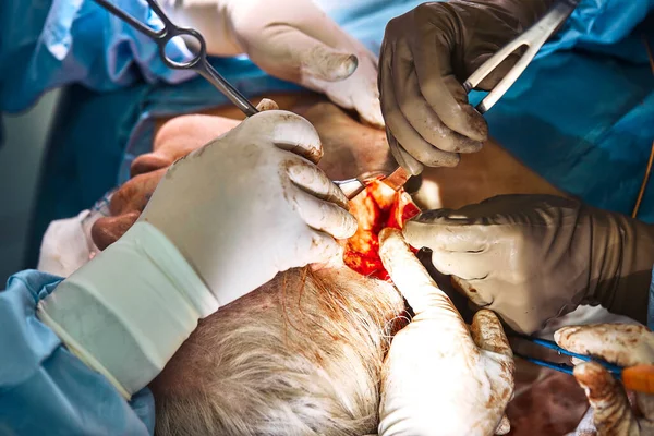 Операция "Подтяжка лица". Настоящая операция, команда хирургов делает операцию на носу. Современная медицина, здоровье . — стоковое фото
