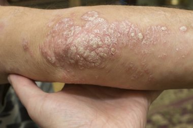 Dermatolojik sorun, sedef hastası bir adamın dirseği.