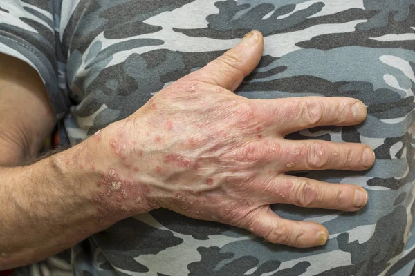 Pele Mão Homem Afetada Por Uma Doença Dermatológica Psoríase — Fotografia de Stock