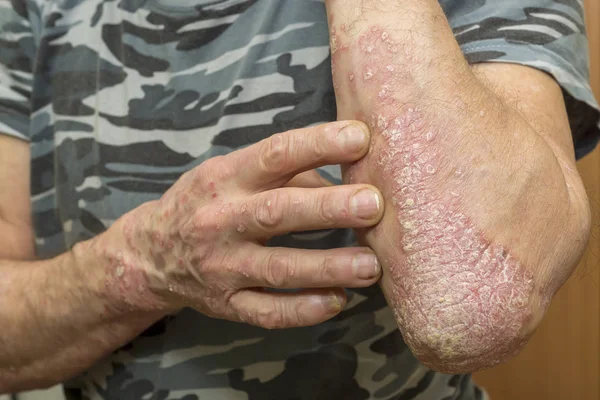 病気の男は 乾癬の影響を受けた皮膚で彼の手を示しています ストック写真