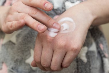 Kız, yumuşatıcı ve nemlendirici bir kremi sürerek ellerin kuru ve tahriş olmuş cildine sürer.