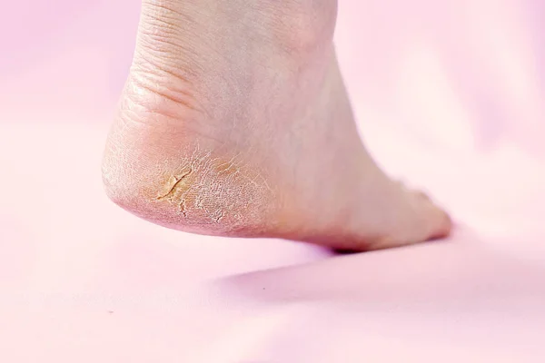 Pembe arka planda kurumuş ciltli, bacakları kırık bir kadın..