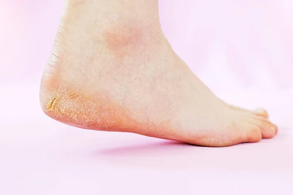 Pembe arka planda kurumuş ciltli, bacakları kırık bir kadın..