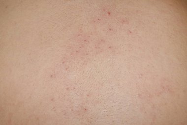 Kirli tarafından neden olduğu sırt sivilce.