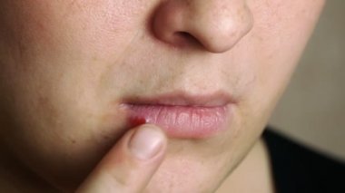 Colds on the lips.Herpes lips.Sore on the woman's face.