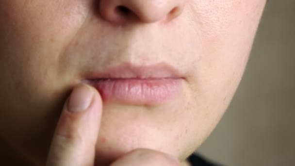 Sore on lip closeup.A woman touches the wound with his finger. — Stock video