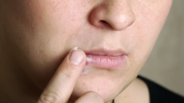 Vrouw wrijft zalf op de wond op zijn lip.Chill op de lippen, koortsblaasjes. — Stockvideo