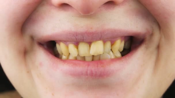 Krzywe żółte zęby z bliska. — Wideo stockowe
