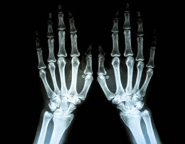 関節リウマチの手のフィルムX線は 手の関節スペースの狭窄を示しています 関節リウマチ患者の手X線で 医療と医療の撮影 放射線概念 — ストック写真