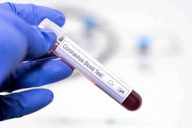 Coronavirus pozitif kan örneği Coronavirus enfekte hastalar 