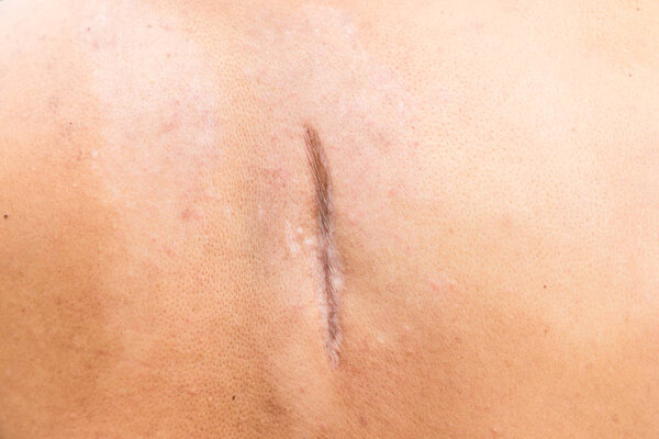 Raised scar. scar after appendectomy. cyanotic keloid scar caused by surgery and suturing, skin imperfections or defects. Hypertrophic Scar on skin