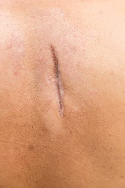 Cicatriz Levantada Cicatriz Después Apendicectomía Cicatriz Queloide Cianótica Causada Por — Foto de Stock