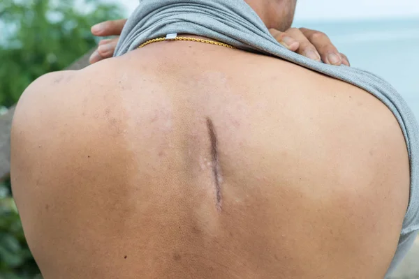 Raised Scar Scar Appendectomy Cyanotic Keloid Scar Caused Surgery Suturing — Stockfoto