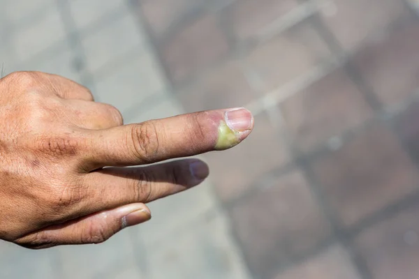 パロニキア 幼児の手の細菌感染による爪のベッドの炎症を伴う腫れた指 爪裂き感染による炎症で腫れた指 — ストック写真