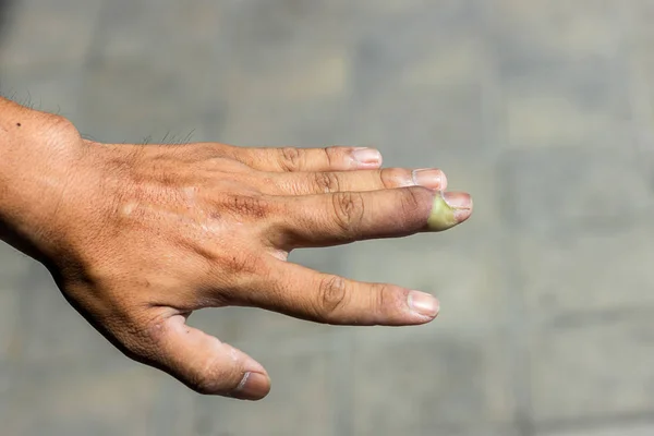 Paronychia Obrzęk Palca Zapaleniem Paznokcia Łóżku Powodu Infekcji Bakteryjnej Ręce — Zdjęcie stockowe