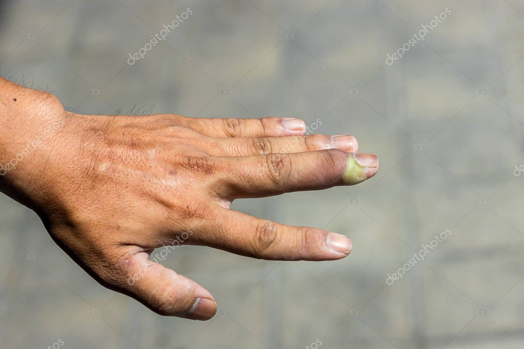 Paroniquia dedo hinchado con inflamación del lecho de las uñas debido